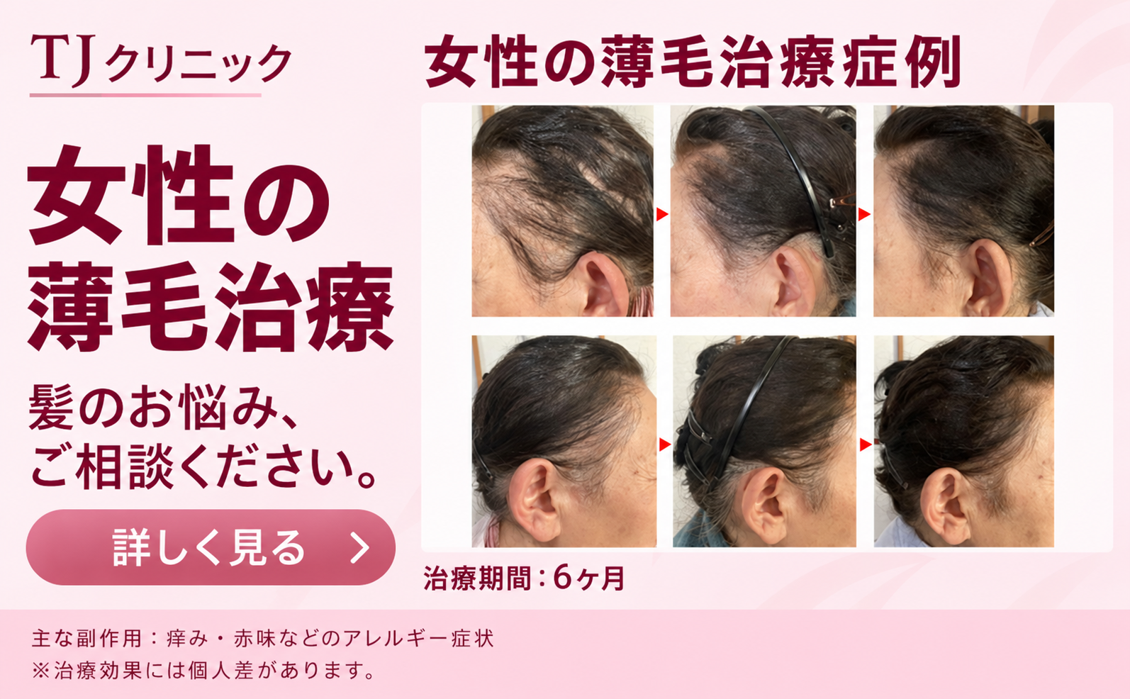 女性薄毛