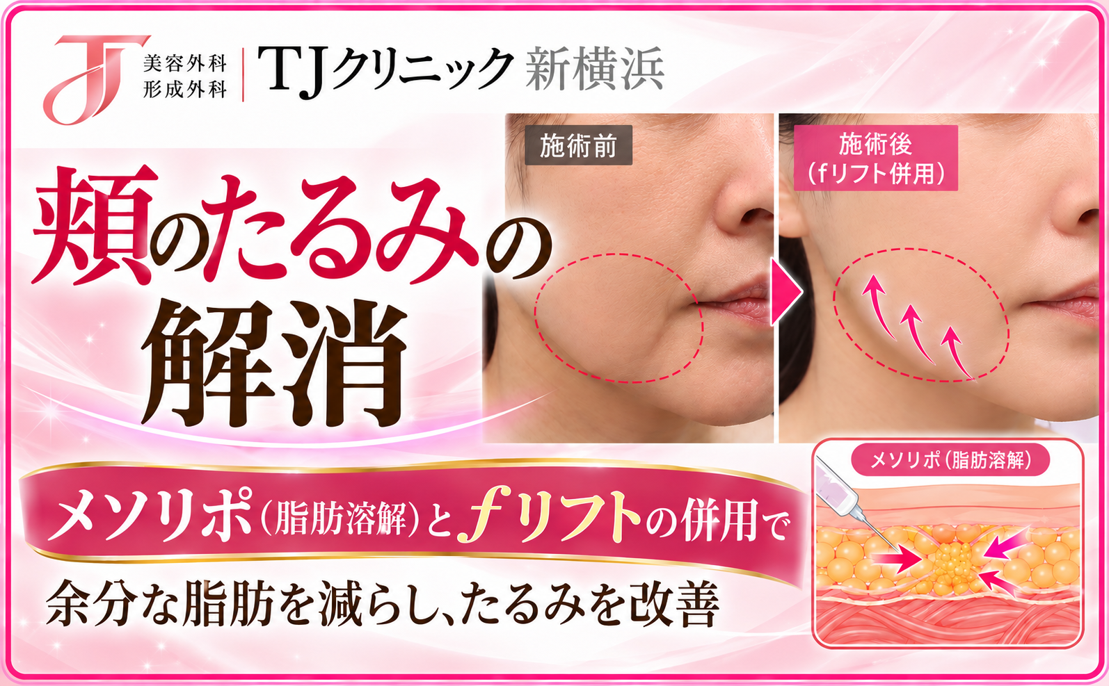 頬のたるみ
