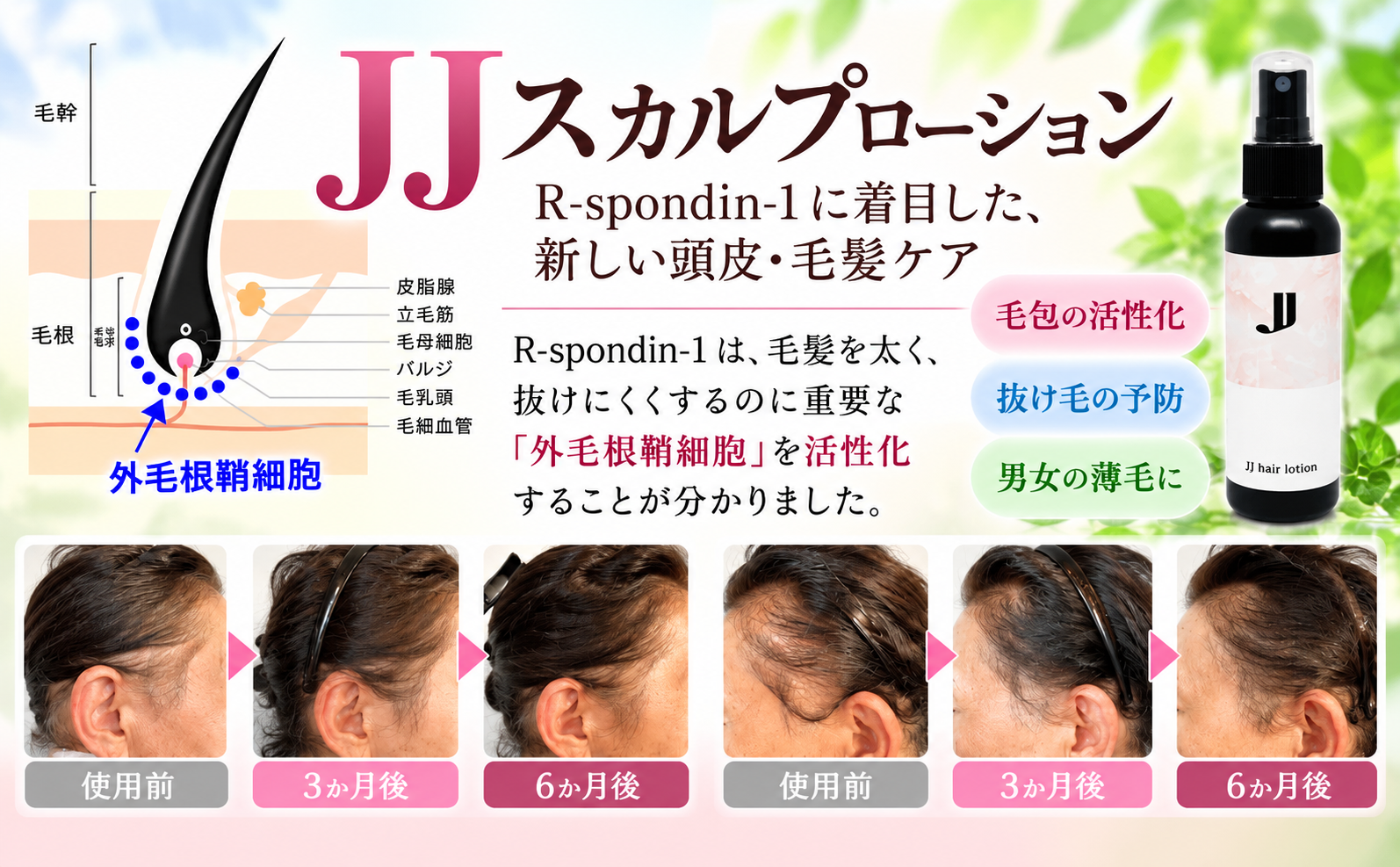 女性の薄毛