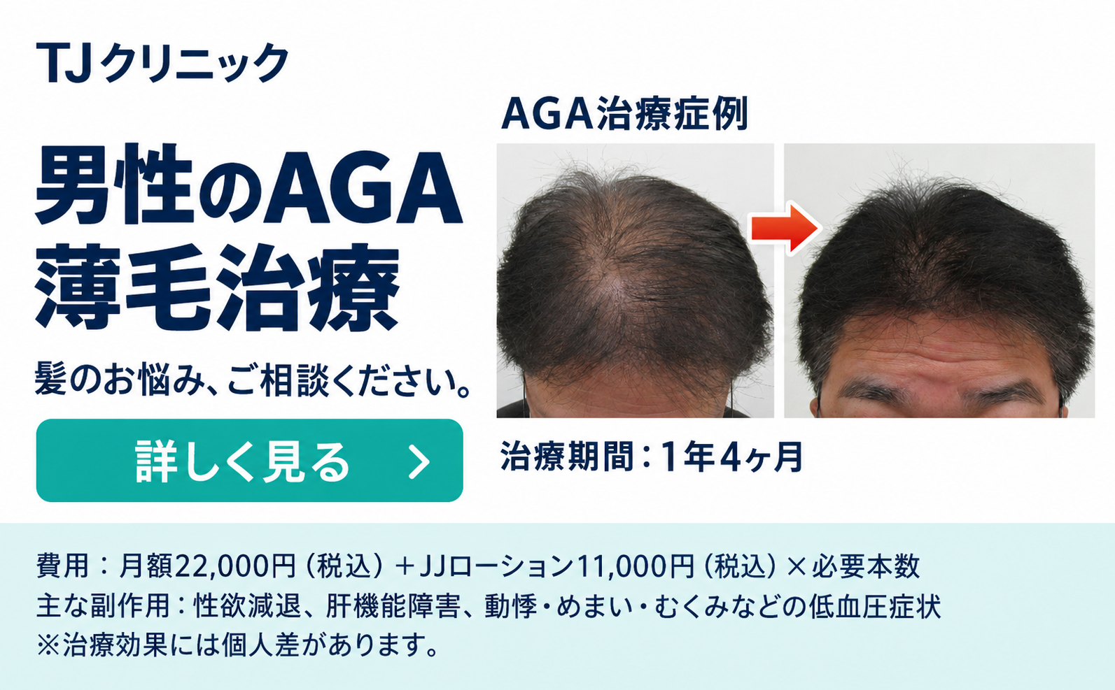 発毛